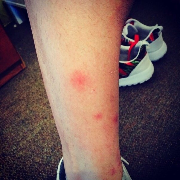 How to confirm a bite is from a bed bug Quora