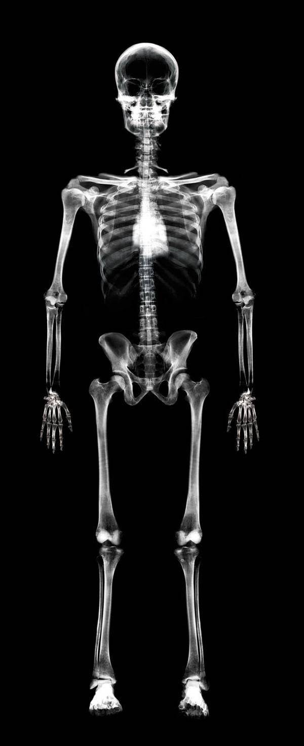 Can breast cancer that has spread to the bones show up on a bone