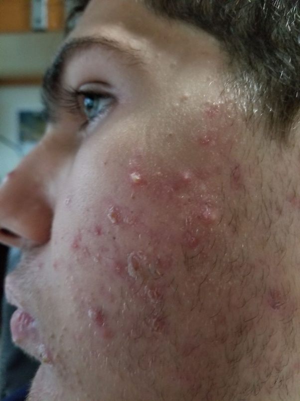 Accutane for 6 months at 20mg and 1 month at 80mg, I still have a lot