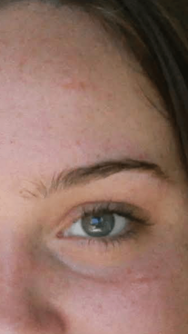 What scar are you ashamed or insecure about? Why? Quora