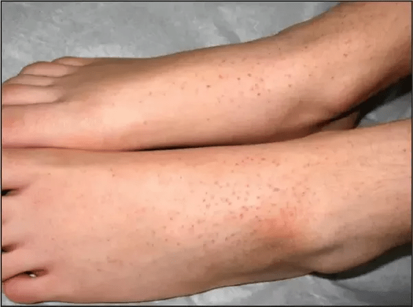 What are some effective home remedies to bring down High Fever? Quora