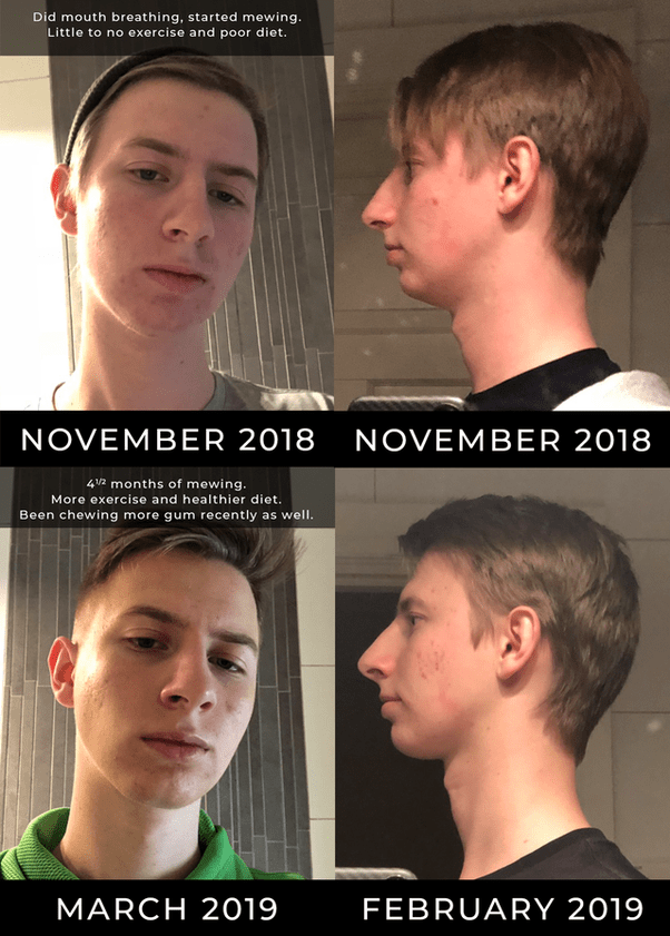 What will improve facial symmetry? Quora