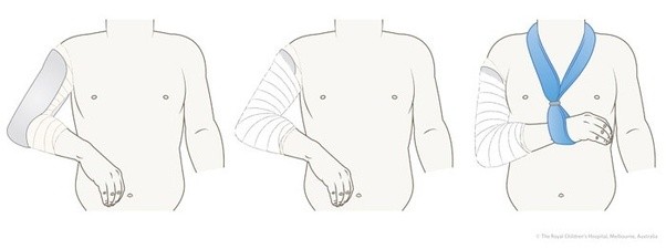 I broke my humerus 8 weeks ago but still am unable to