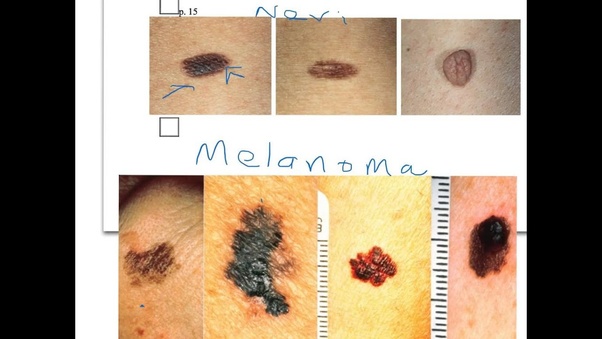 Why do some people think that moles on your eyelids are dangerous? Quora