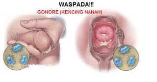 Fungsi Obat Penis Nyeri Saat Buang Air Kecil Bernanah Denature - HERBAL  OBAT DE-NATURE