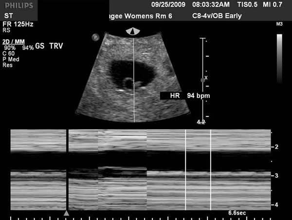 How soon can an ultrasound confirm your pregnancy? Quora