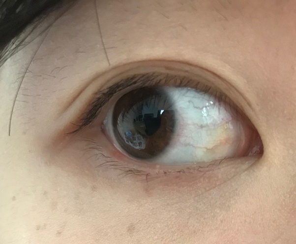 Why are there sometimes redness around my iris? Quora