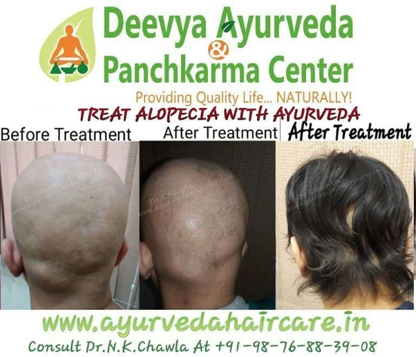 Does hair loss regrow in males after alopecia areata? Quora