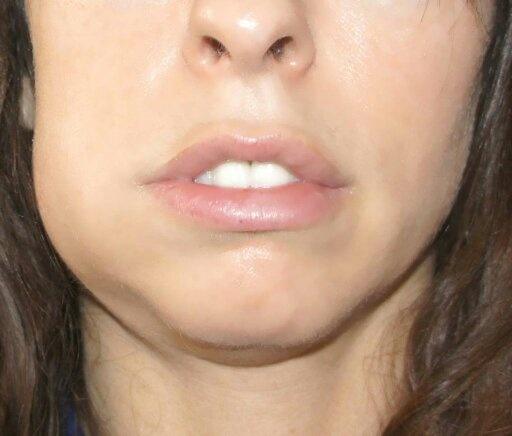 Does a tooth abscess cause the face to swell? Quora