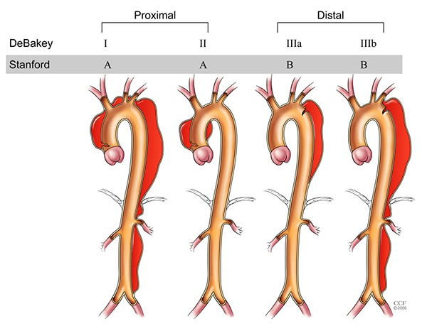 How to know if you have an aortic dissection Quora
