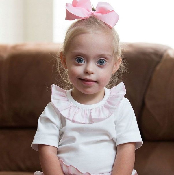 Why does every little girl with Down’s syndrome look exactly the same