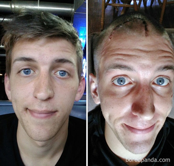 What are some greatest before and after cancer pictures? Quora