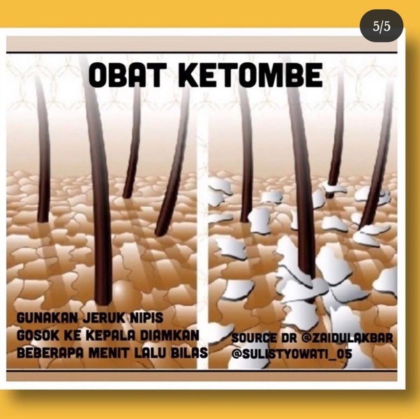 Bagaimana caranya untuk menghilangkan ketombe pada kulit kepala? Quora