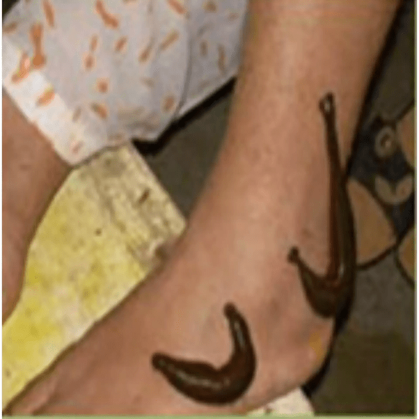 How to can remove blood clot from the legs with Ayurvedic medicine Quora