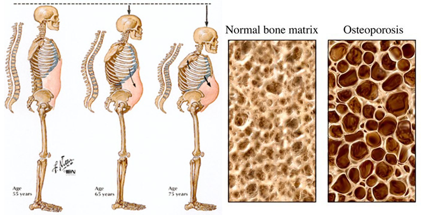Bagaimana cara mengobati osteoporosis - Quora