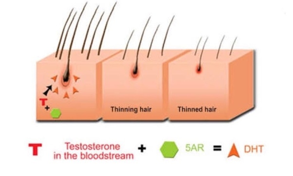 How to remove DHT from my scalp Quora