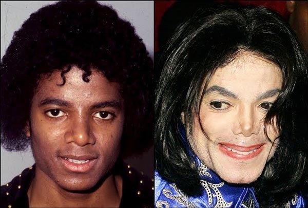 What caused a bigger change in Michael Jackson&#039;s appearance, vitiligo