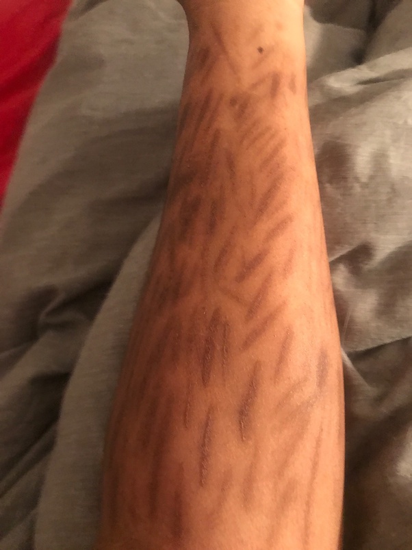 What do your self harm scars look like? Quora