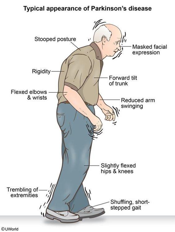 What are the symptoms of parkinsons? Quora