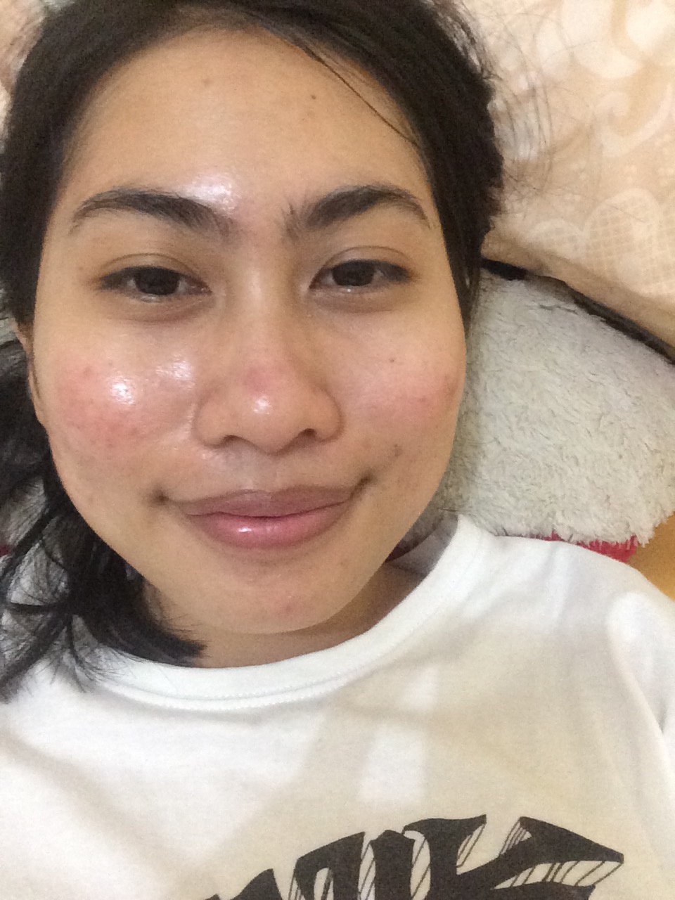 Bagaimana cara menghilangkan bekas jerawat yang berwarna merah? Apakah ada  saran produk yang bagus? - Quora