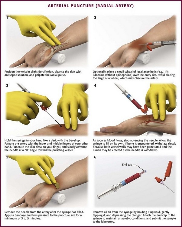 DO WE PUNCTURE ARTERIES/ VEINS WHEN testing BLOOD? Quora