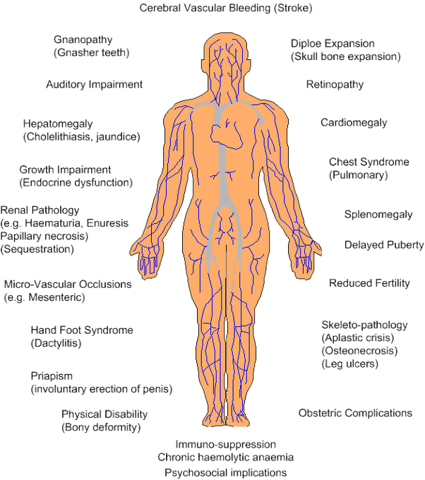 What is the basis of sickle cell anemia? Quora