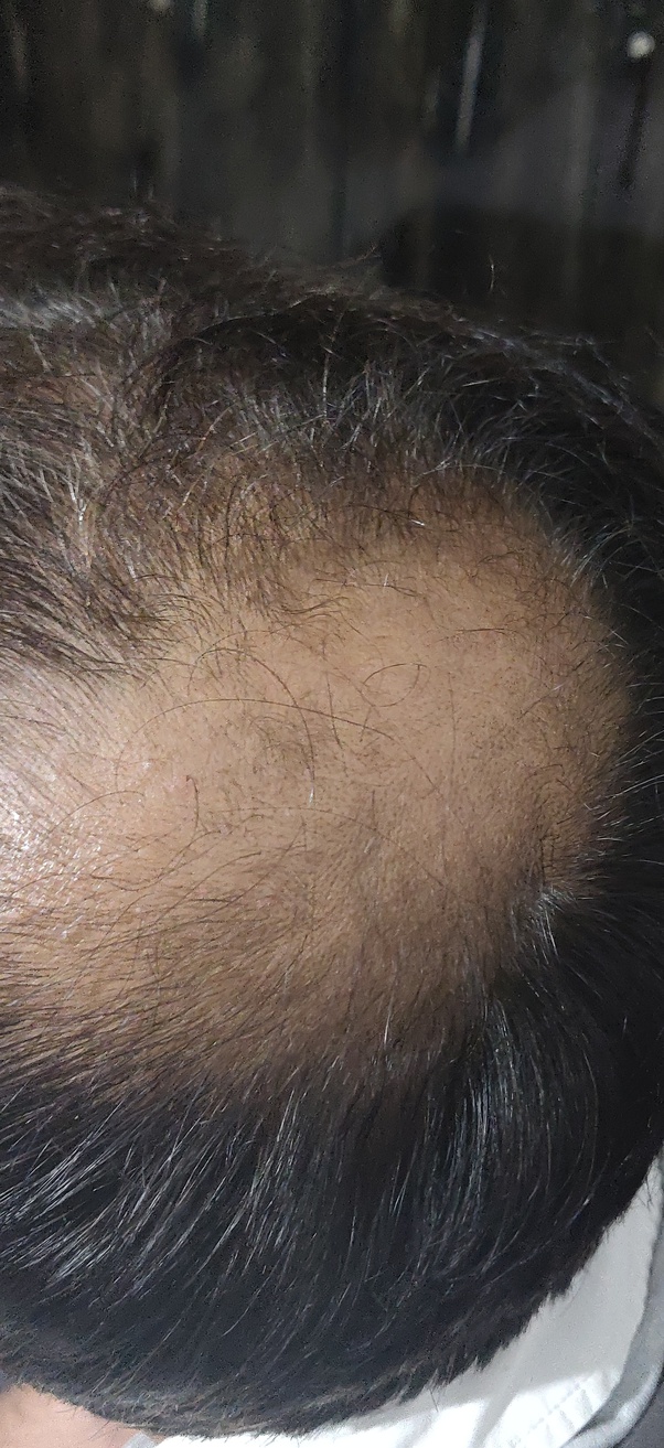 Benefits Of Onion Juice For Hair Quora health benefits