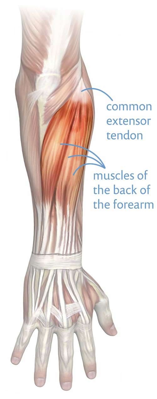What is the permanent cure for tennis elbow? Quora