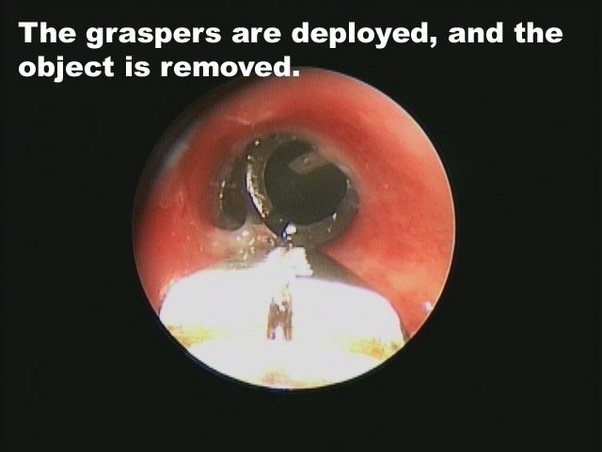 What happens if a grain of rice falls into or enters my lungs? Quora