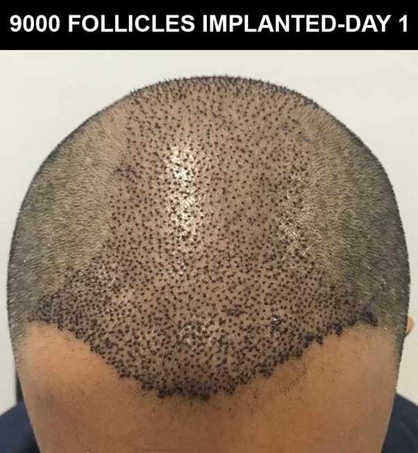 Which is the Best hair transplant centre in Bangalore? Quora