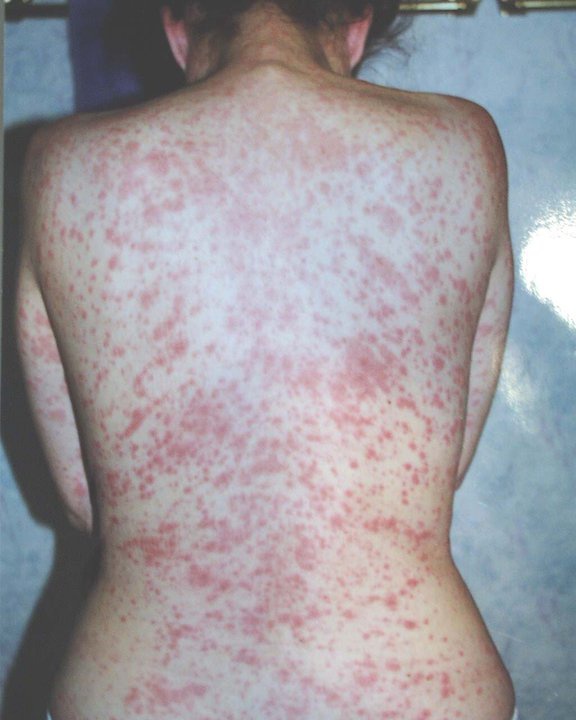 How Long Does Cat Scratch Disease Take To Heal wallpaper hd