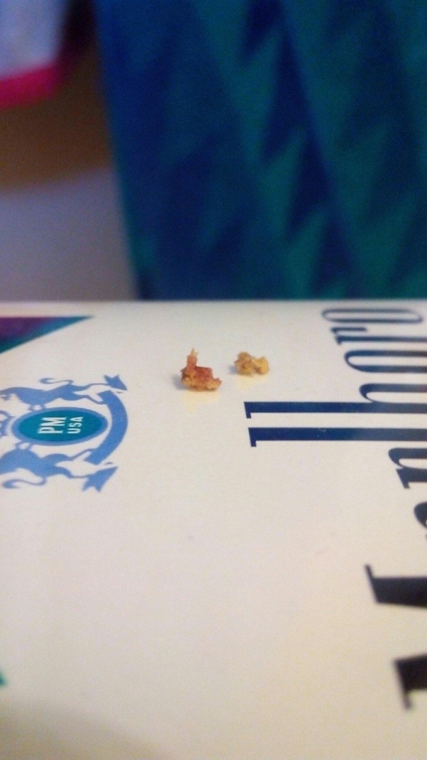 What does it feel like to pass a kidney stone? Quora