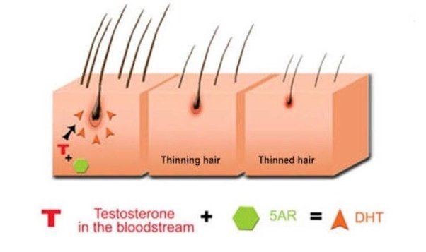 Does high dht cause dandruff? Quora
