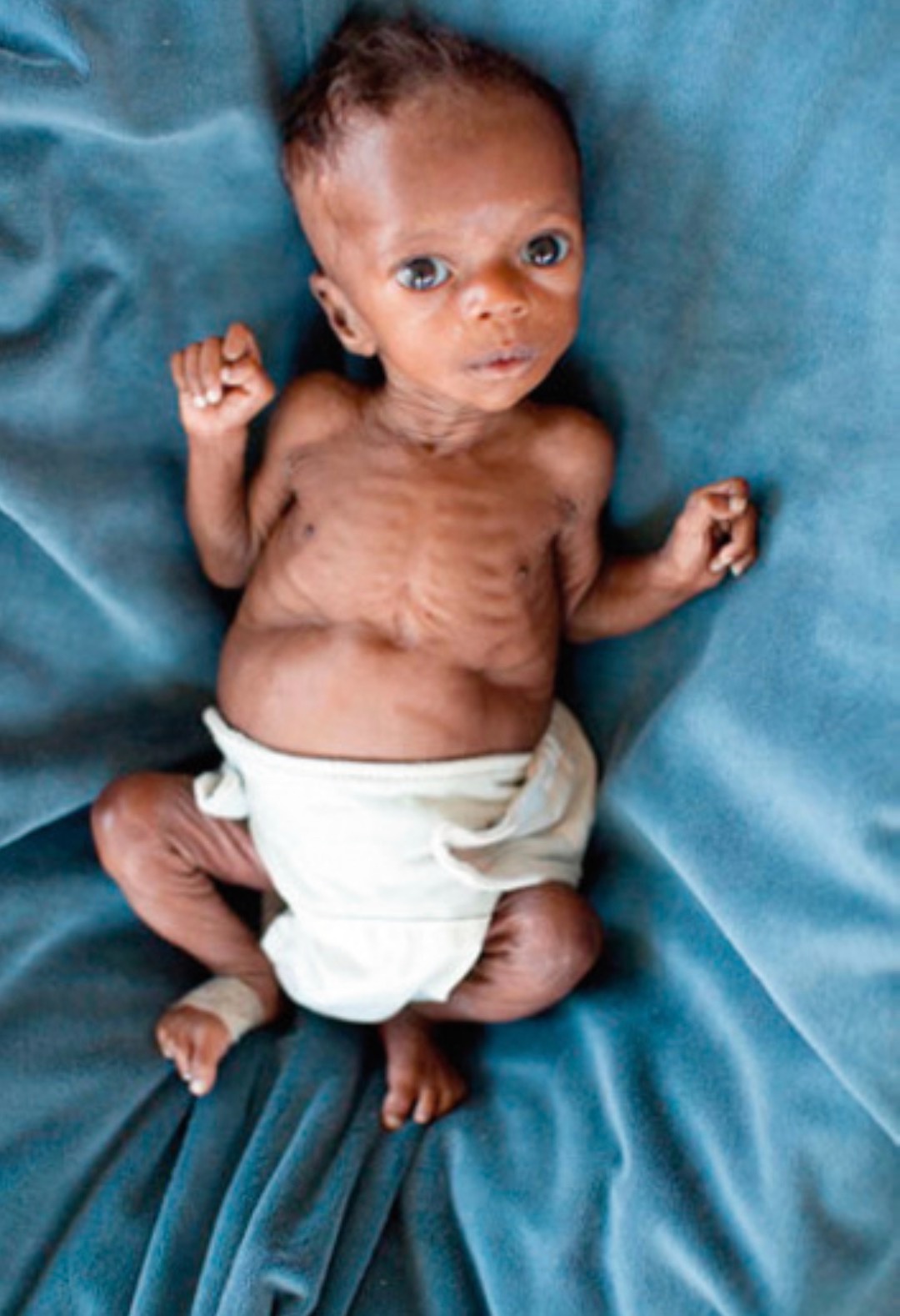 Apa patogenesis di balik marasmus dan kwashiorkor? - Quora