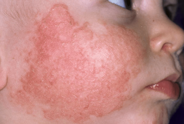 Why do babies cheeks get red? Quora