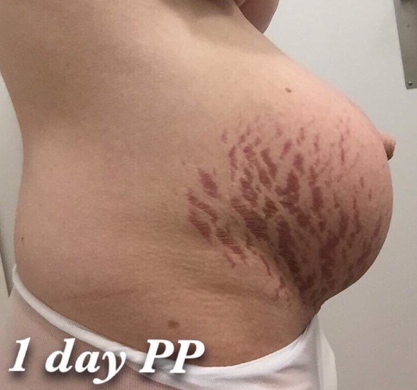 Why is Meghan’s belly still looking big even after giving birth to a