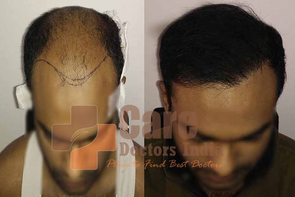 How much does it cost to get hair transplant in Australia? Quora