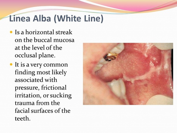 What are the treatments? I have linea alba on my cheek, they say its