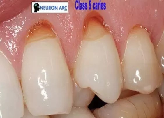 What Causes Gum Line Cavities Quora