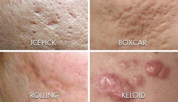 How many days does it take for the pimple marks to fade? Quora
