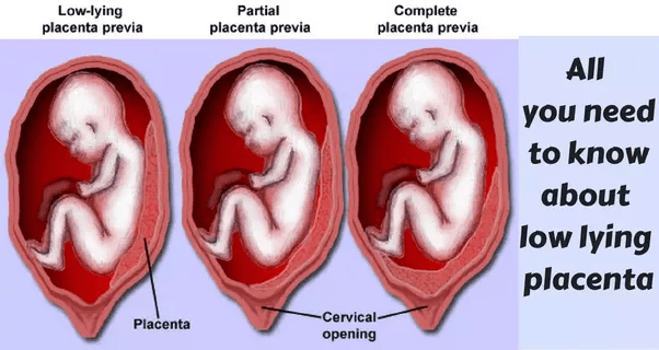 What are the concerns of having a low lying placenta after