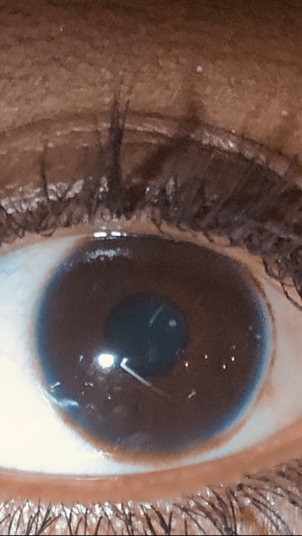 Is it normal for a black person to have a blue ring around