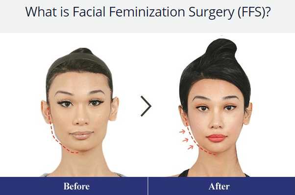 What plastic surgery can make my face look more feminine? Quora