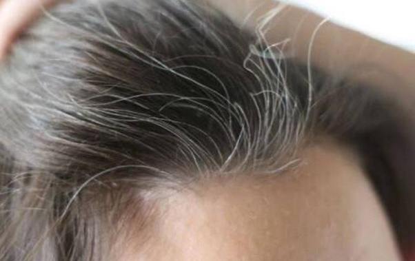 How to remove white hair Quora