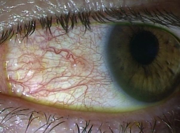 Why does my eye produce a blot clot or red vein when I take out my