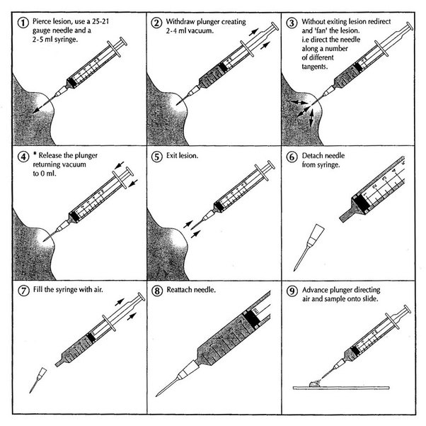 Needle Aspiration Procedure