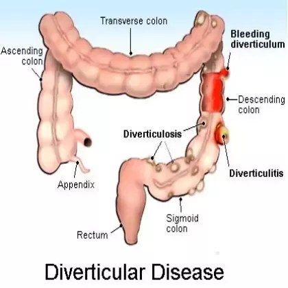 What Causes Pain In My Lower Abdomen When I Walk? - Quora