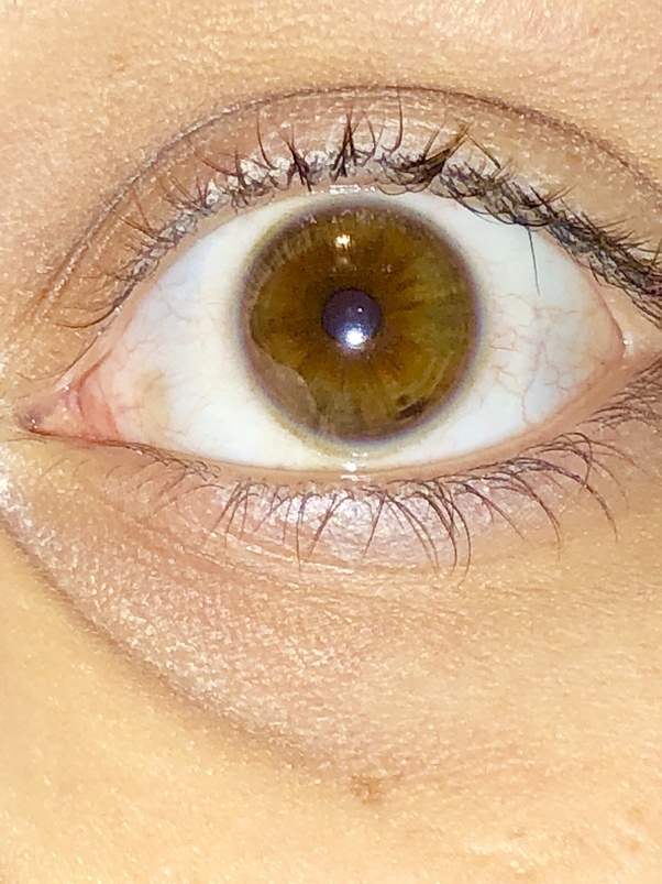 What causes a dark spot on the iris of my eye? Quora