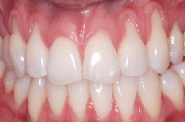 Why can brushing your teeth too hard damage them, but the sharp metal