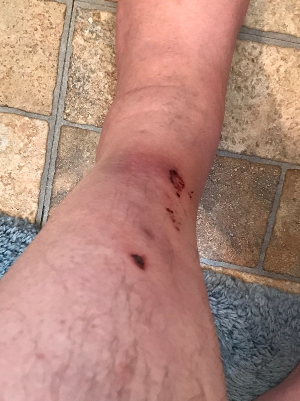 Why do I wake up with mysterious scratches in my body? Quora